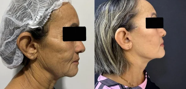 Resultado natural após facelift endoscópico — antes e depois